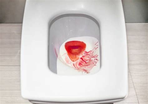 iyot sa pwet|Pagdudugo ng Pwet: Dahilan at Gamot Para Dito .